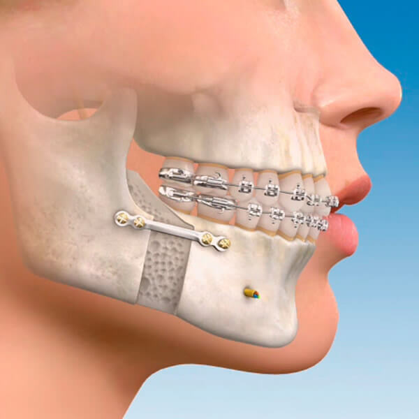 Cirugía Periodontal