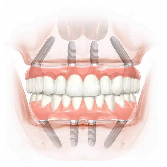 Implantología <br> <br>