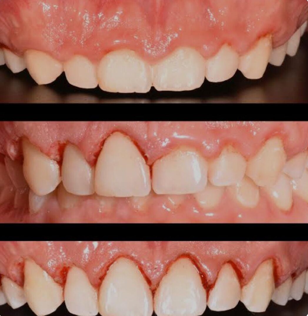 Cirugía Periodontal